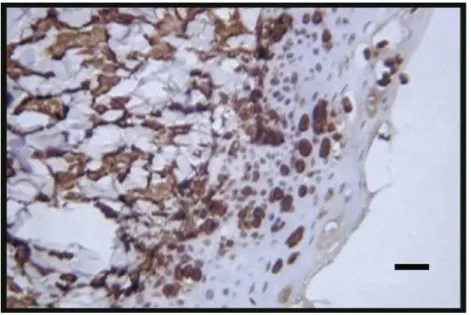 Fig 3. Melan - A positive immunoreaction of  the tumour. Bar = 100 μm 