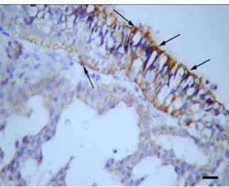 Figure 4. Caspase-3 expression in the cytoplasm of  tumour cells (arrows). Streptavidin biotin method