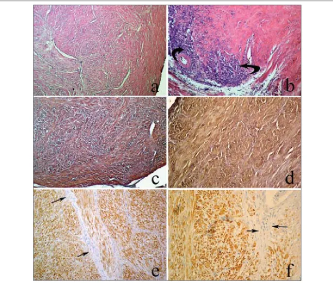 Fig 2. Microscopic (A, B and C) and immunohistochemical (D, E and F) feature of leiomyomas