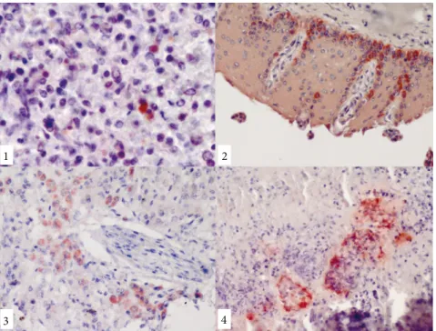 Figure 1-4. Positive reactions for Neospora caninum antigen, the ABC immunoperoxidase  technique, Mayer’s hematoxylin counterstaining:1-lymph node, granular immunoreactive  stainings for N