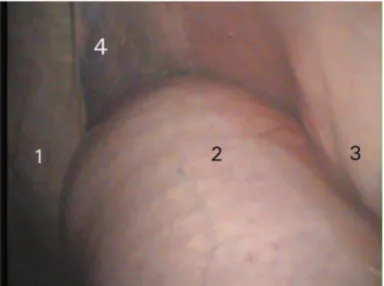 Şekil 2.8. Sola  deplase  abomasumun  laparoskopik görünümü  (1:  abdominal  duvar,  2:  abomasum,  3: rumen, 4: dalak) [Yiğitarslan (2007)’dan alınmıştır].