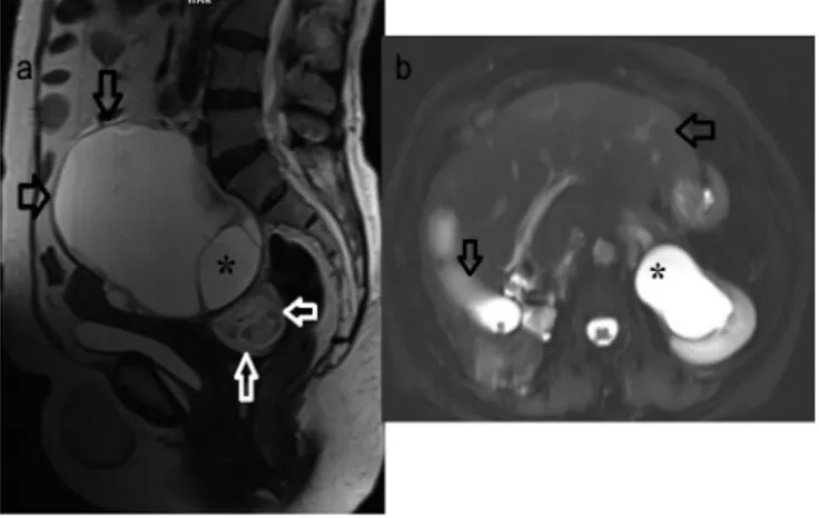 Figure 1. a) Sagittal T2-weighted MRI demonstrated (*) type 3  hydatid cyst (black arrows) with daughter vesicles located at the  posterior of the uterus, and type 2 hydatid cyst with detached  membrane in lesion posterior-interior (white arrow), b) Axial 