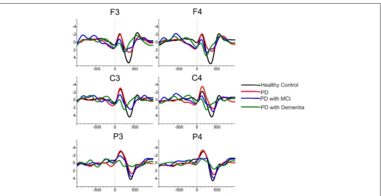 FIGURE 4 | The grand average of delta responses upon application of target stimuli for healthy controls (black line), for Parkinson’s disease without cognitive deficit (red line), for Parkinson’s disease with MCI (blue line) and for Parkinson’s disease wit