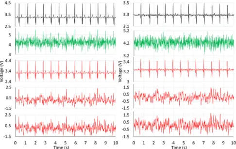 Table 2. MSE of noisy LA and C-ECG signals filtered by LMS, recursive least squares (RLS), and  extended kernel recursive least squares (EKRLS)