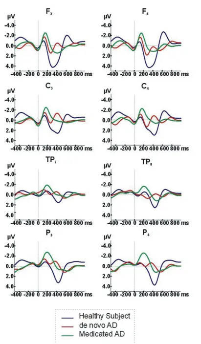 Fig. 1. Auditory event-related oscillations (ERO) delta (0.5-3.5 Hz) Responses to target stimuli in Alzheimer’s disease (AD) groups and healthy elderly controls.