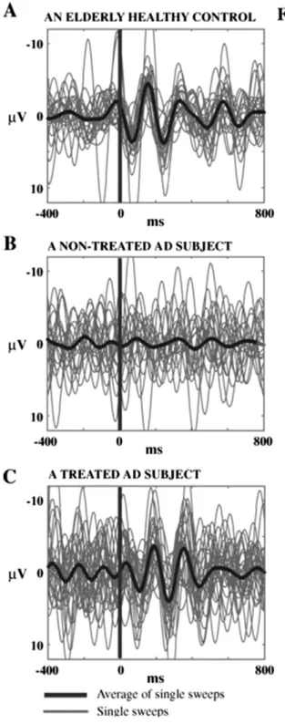 Fig. 14 shows no difference in mean Z-values for theta frequency range upon application of “simple light” stimuli for all electrode pairs between healthy controls and AD subjects