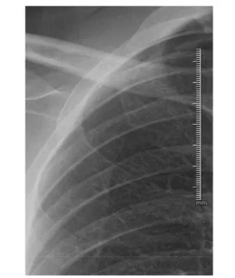 Fig. 6 – The pneumothorax was fully recovered without any intervention  on the third day