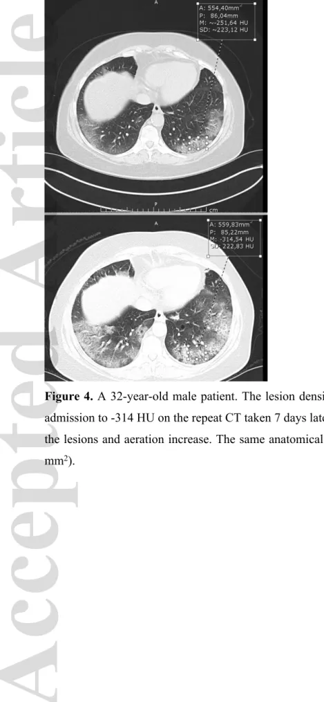 Figure 4. A 32-year-old male patient. The lesion density value was decreased from -251 HU on  admission to -314 HU on the repeat CT taken 7 days later despite the increased size and number of  the lesions and aeration increase