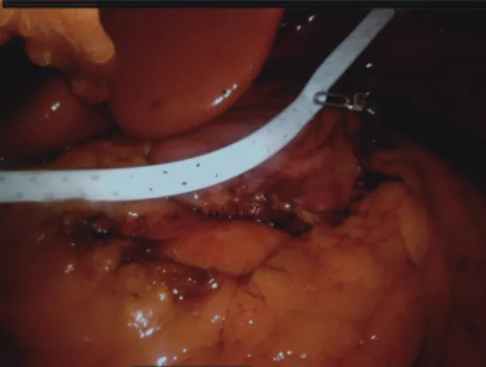 Figure 14 Jackson-Pratt drain placed near sleeve tube through right  port.