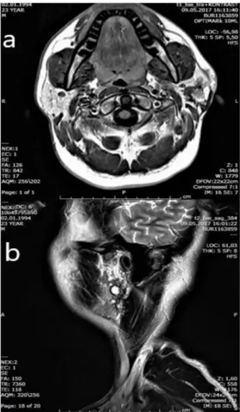 Figure 1. The left parotid gland MRI section, multiple  pleomorphic adenoma: a. T1-weighted isointense  (axial)