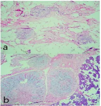 Figure  3.  Histopathology  of  the  tumor:  a.  A  noduler  patterned  stroma  included  tumoural  area  with  the  neigborhoodof  the  benign  parotid  gland  (x40  H&amp;E)