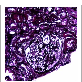 Figure  1.  (c) Renal  biopsy  by  light  microscopy, glomerulosclerosis  and  visceral  epithelium proliferation (Periodic acid–Schiff; ×200)