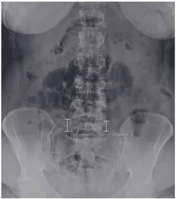 Figure 1. Castellvi radiographic classification Type Ia