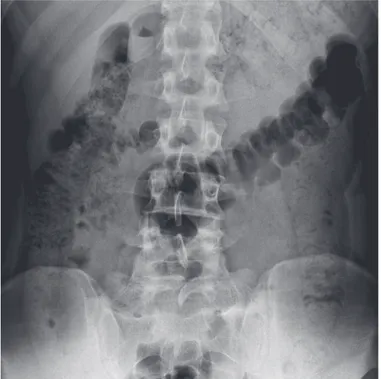 Figure 7. Castellvi radiographic classification Type IVFigure 6. Castellvi radiographic classification Type IIIb