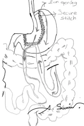 FIG. 1. Scheme of BMGM (NOTE: drawn by A. Sumer,  one of the authors). BMGM, bridged mini gastric bypass