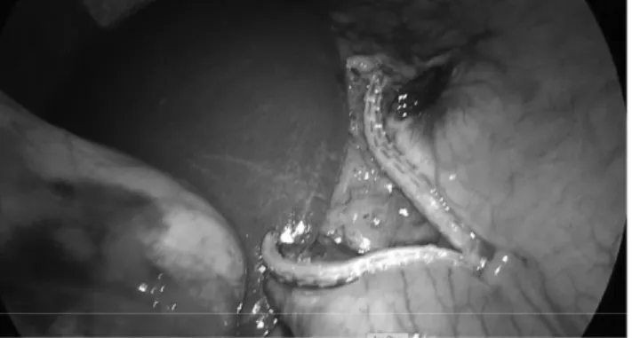 FIG.  2.  Creation  of  an  opening  in  the  hepatogastric  liga- liga-ment at the level of incisura angularis