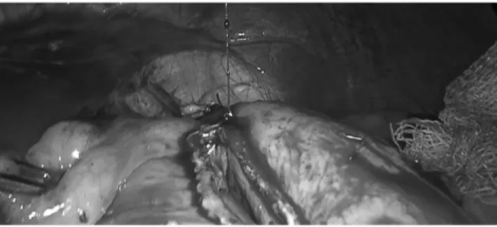 FIG.  6.  Depending  of  thickness  of  gastric  wall  placement  of staplers. 