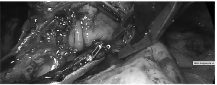 FIG. 10. Check for hemostasis and placement of clips  when necessary. 