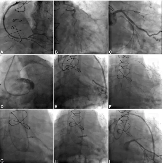 Figure 1.  ABC. Same Patient’s Angiography in one year ago, (A) Picture of “LIMA-LAD graft” imaging