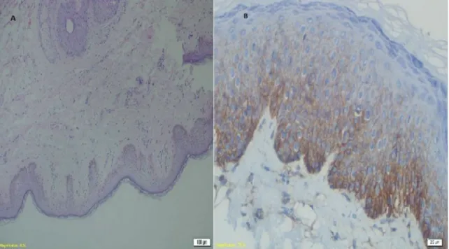 Figure 1. A: Normal vulvar tissue stained with hematoxylin and eosin (HE ×20 magnification) and B: Staining of CD 44 antibody in normal vulvar tissue (at ×40  magnification)