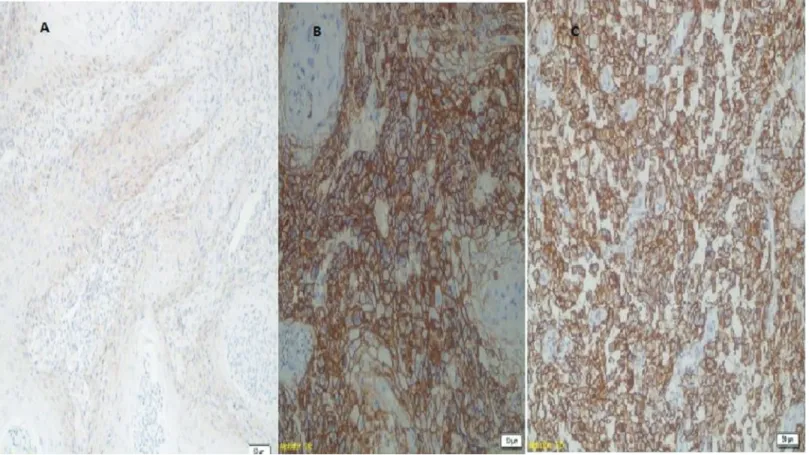 Figure 2. A: CD44 expression in well-differentiated tumor, B: in moderately differentiated tumor and 2C: in poor differentiated tumor (at ×20 magnification).