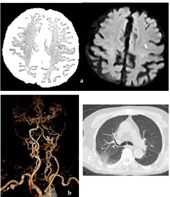 Table 4. CTA / MRA findings of COVID-19 positive stroke  group 