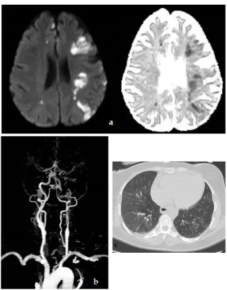Figure 3. 55 years female, application with speech loss,  PCR  test  is  positive.  is  shown  in  CTA