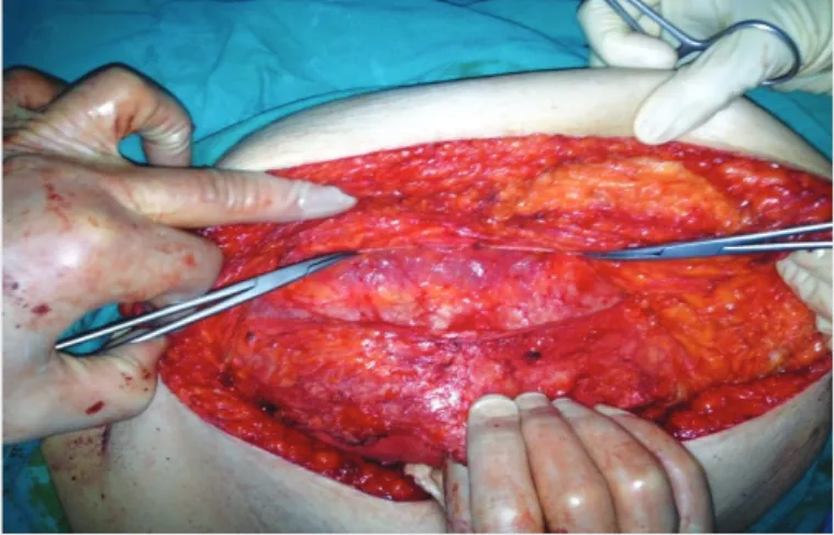 Figure 3. Completed version of bilateral separation