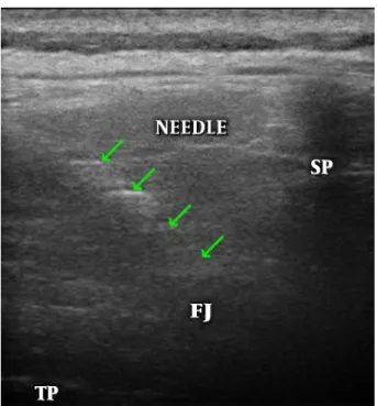 Figure 1. Ultrasound guided injection. FJ, facet joint; SP, spinous process; TP, trans- trans-verse processes.