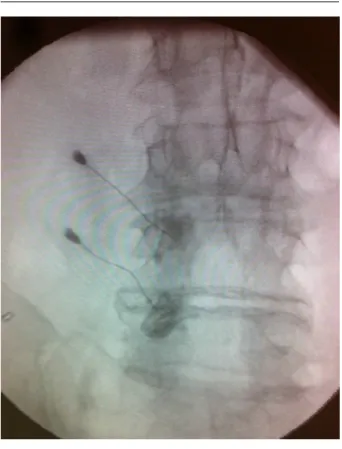 Figure 2. Control of facet joint with contrast agent in fluoroscopy