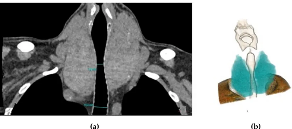 Figure 2. Coronal reformat (a) and 3D colored volume rendering (b) computed tomography (CT) images show the enlarged thyroid gland compressing the trachea.