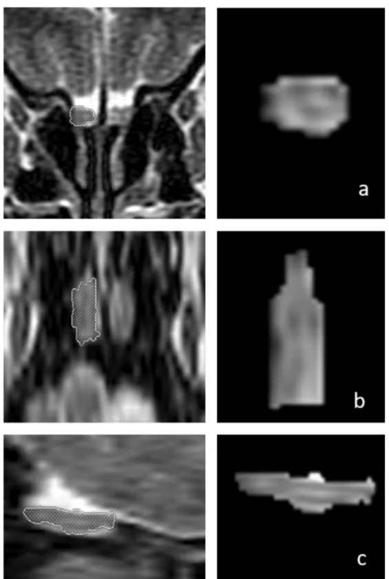 Figure 1 Three-dimensional measurements of the right olfactory bulb (OB) volume in a 66-year-old male patient on T2-weighted coronal (a, ﬁrst row), axial (b, middle row), and sagittal (c, bottom row) magnetic resonance images