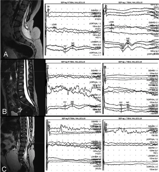 Figure 3: (A) 16-year-old female patient. She was operated for MMC closure in the first 48h  of life