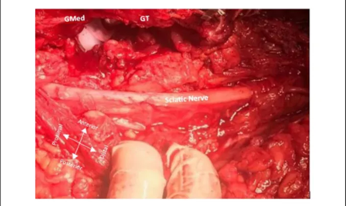 Figure 3. Intra-operative view of the left hip wih posterior approach. The gluteus maximus tendon was identified, and tenotomy was performed with consideration of the sciatic nerve passing under it (L: left).
