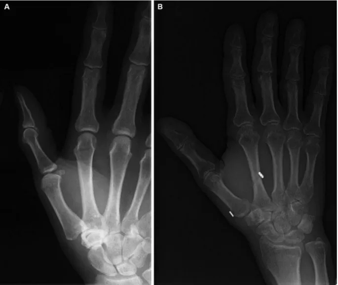 Fig. 3 (A) Preoperative radiographs of a 47-year-old man with a first CMC Eaton–Littler stage 2 arthrosis