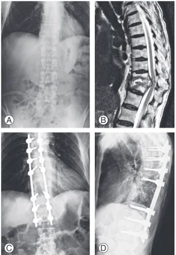 Fig. 1.  A 55-year-old patient with breast cancer. (A, B) Anteroposte- Anteroposte-rior radiograph and sagittal magnetic resonance image showing the  collapse of the T–12 vertebra because of metastatic breast cancer