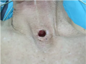 Figure 1: Preoperative image of a tracheostomy.
