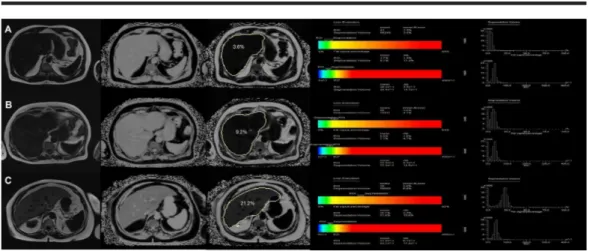 FIGURE 2: Examples of the multi-echo Dixon (left) and magnetic resonance spectroscopy (right) in three different participants with different percentages of proton density fat fraction values at ROI