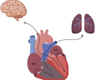 Figure 1 – Schematic illustration of left atrial thrombus causing ischemic stroke and right atrial thrombus causing pulmonary embolism.
