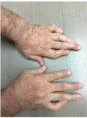 Fig. 1. Psoriatic arthritis involvement and defor- defor-mity of the hand joints.