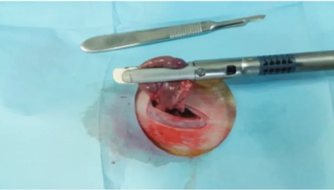 Figure 1. Sleeve gastrectomy model.