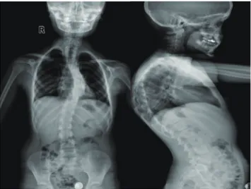 Fig. 4. Last follow-up AP/lateral X-ray of patienttreatedwith TGR  technique. AP : anteroposterior, TGR : traditional growing rod.