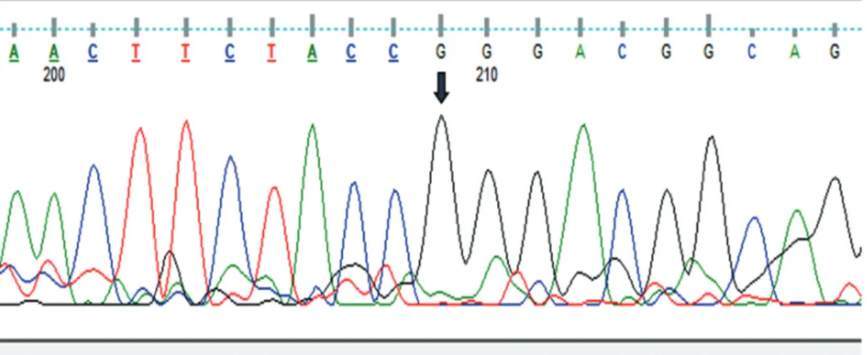 Figure  2.  DNA  sequencing  chromatogram  of  the  patient.  The  arrow  indicates  a  homozygous  NM_000208.4  c.779  T>G  (p.Leu260Arg) mutation in exon 3 of the INSR gene