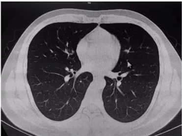 Figure 1  Thorax CT of patient with familial Mediterranean fever– COVID-19 showed normal finding.