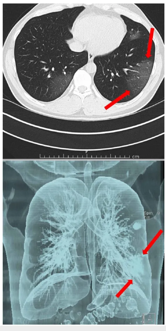 FIGURE 3: CT examination of the same patient 2 days later