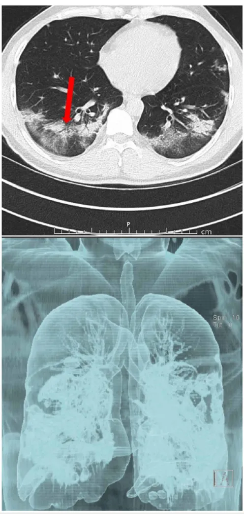 FIGURE 4: CT examination of the same patients 12 days later