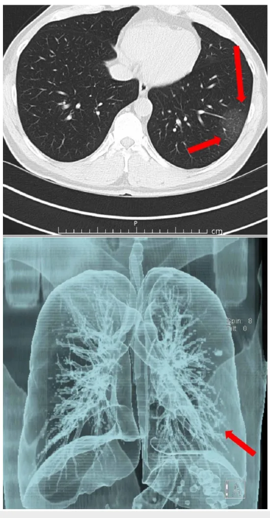 FIGURE 2: At the same examination, a lesion of gross ground