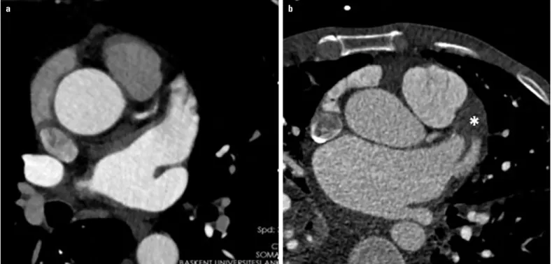 Figure 18. LA appendage by MDCT. (a) No thrombus and (b) presence of thrombus within the LA appendage seen on late phase contrast (Asterix)  (Courtesy of Dr