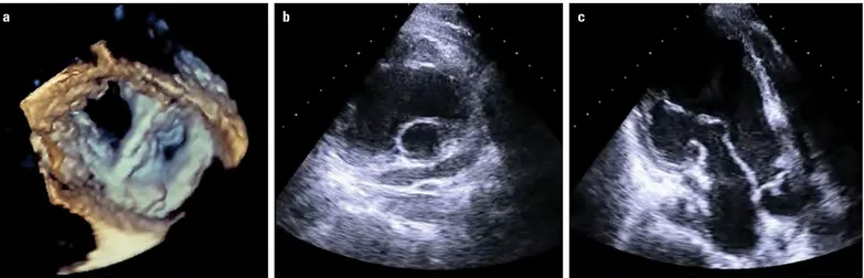 Figure 4. Congenital mitral stenosis. (a) 3D rendered display of double orifice MV from LA perspective, (b) parachute MV from parasternal short  axis, and (c) apical long axis views (Videos 4a–4c)