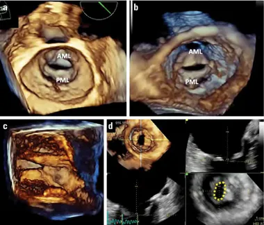 Figure 5. Imprecise stenotic MVA depending on the 2D transverse cut  plane due to a funnel-shaped stenotic orifice